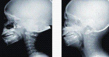 Alta proyección de imagen de diagnóstico de la cobertura X Ray de la tinta, película médica del rayo de x del laser de 35 de los x 43cm