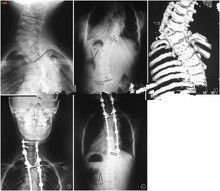 Alta proyección de imagen de diagnóstico de la cobertura X Ray de la tinta, película médica del rayo de x del laser de 35 de los x 43cm