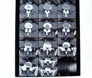 el 10in * el 12in películas secas de alta densidad de la proyección de imagen médica del 11in * del 14in para la impresora de AGFA/de Fuji