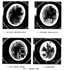 Good price Pulgada médica del papel 8×10 de la película seca transparente de la impresora laser X Ray en línea