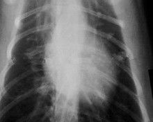 Niebla baja 11 x película de radiografía de papel 14 para las impresoras laser médicas KND-K