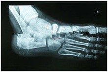 Good price papel médico de la proyección de imagen de diagnóstico degradable de X Ray del 13in del x 17in para la impresora laser en línea