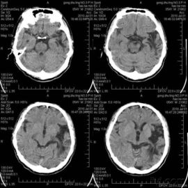 Good price Proyección de imagen médica resistente al rayado de X Ray para la impresora laser de Konida en línea