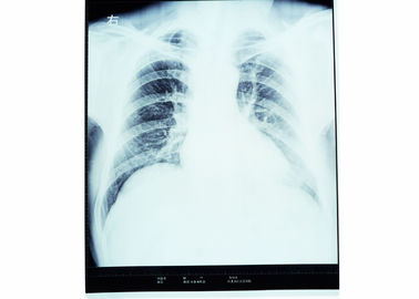 Good price Impresora térmica de la película seca médica de X Ray del pecho para AGFA el 14in el x 17in en línea