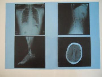 Good price Película seca médica de la proyección de imagen de la niebla baja de KND-A para el examen de X Ray en AGFA 5300/5302/5500 en línea